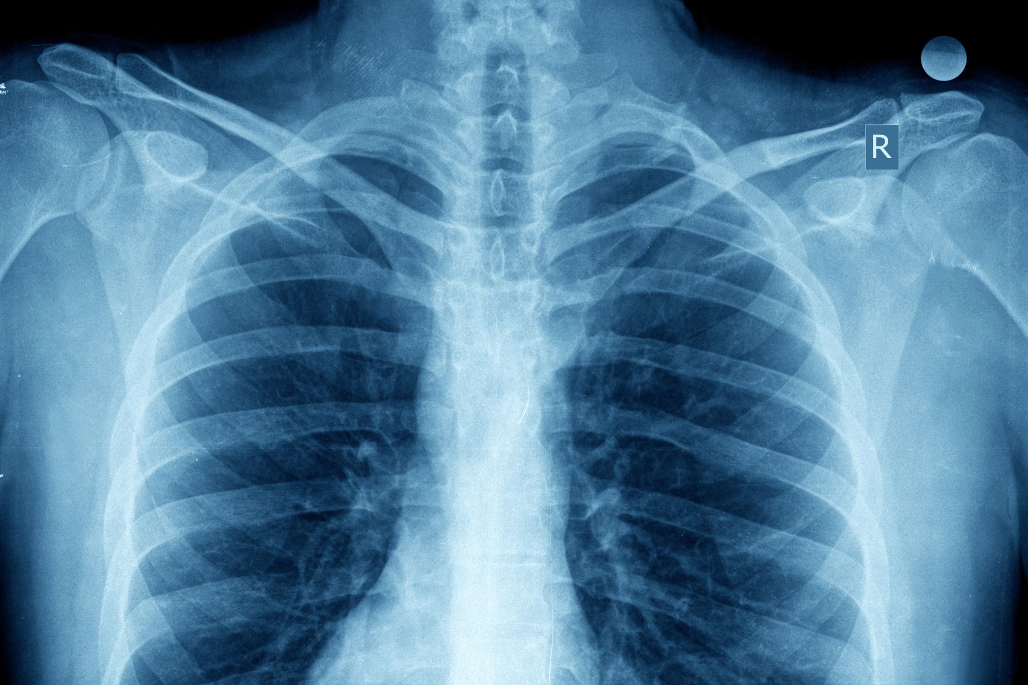 Full spine X-ray image demonstrating vertebral count and spinal contour analysis in Gonstead chiropractic.